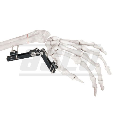 Distal Radius Fragment External Fixator Articulated Minirail Fixator