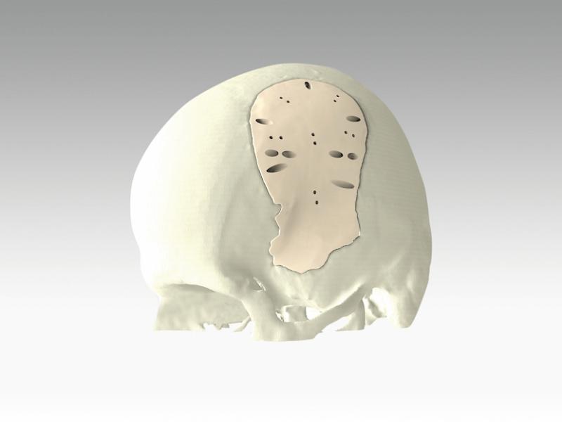 SKULL IMPLANT evo_SHAPE.