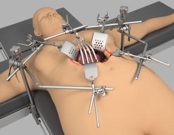 Bariatric Retractor | General Surgery | Thompson Surgical Bariatric Retractor | General Surgery | Thompson Surgical