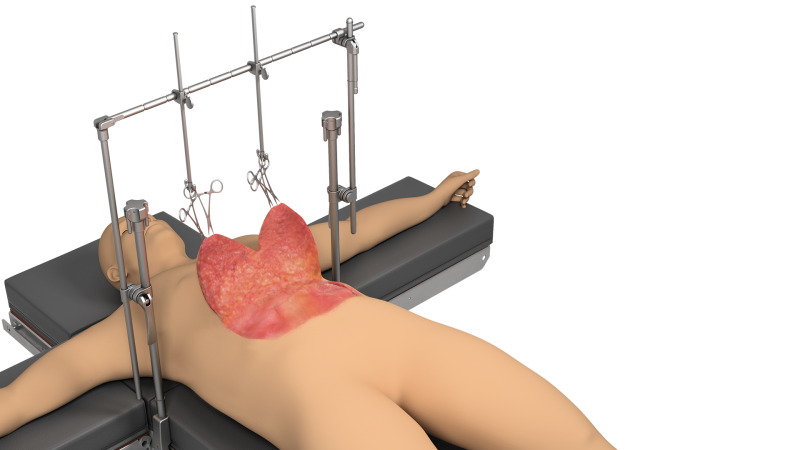 Body Contouring Retractor | Plastic Surgery |Thompson Body Contouring Retractor | Plastic Surgery |Thompson