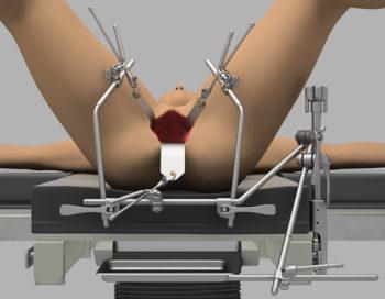 Colon & Rectal Retractor System |Thompson Surgical Colon & Rectal Retractor System |Thompson Surgical