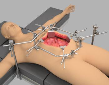 HIPEC Oncology Retractors | Surgical Retractors | Thompson HIPEC Oncology Retractors | Surgical Retractors | Thompson