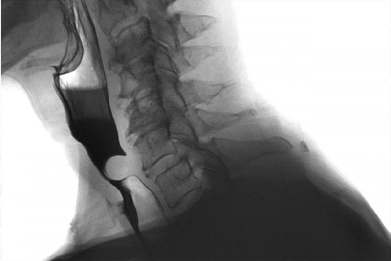 Dysphagia swallowing cleft palate 