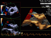 TAVR with color