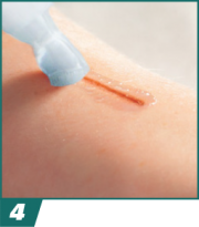 Exofin® Topical Skin Adhesives Application